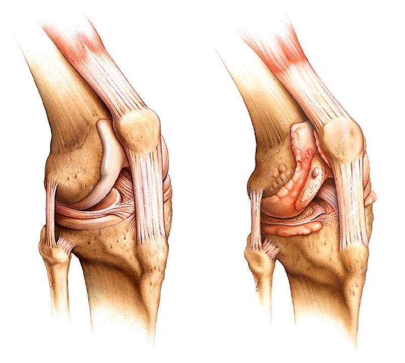 Articulación sa (esquerda) e articulación artrítica (dereita)