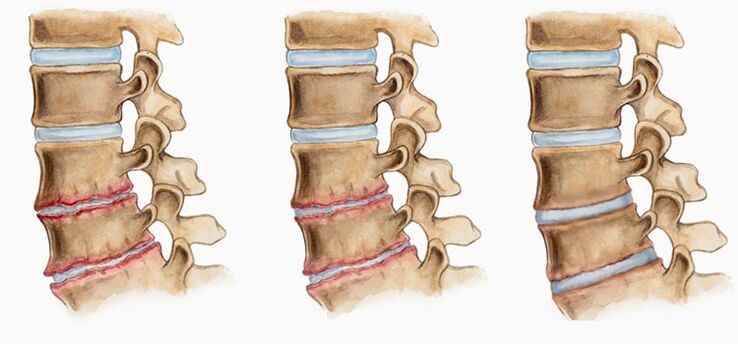 A deformación dos discos intervertebrais na osteocondrose pode causar dor nas costas