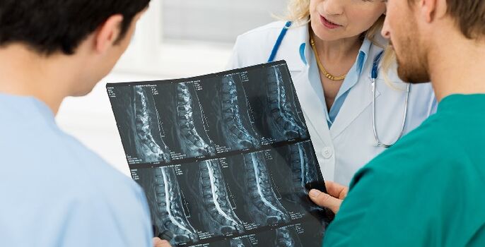 Radiografía da columna vertebral empregada para diagnosticar a osteocondrose