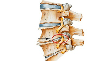 Disco intervertebral pellizcado na columna vertebral como causa de osteocondrose cervical