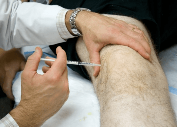 Administración intra -karticular de analxésicos con dor grave