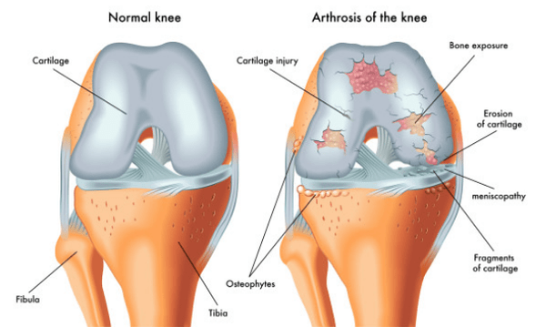 Articulación normal e influenciada pola osteoartrite